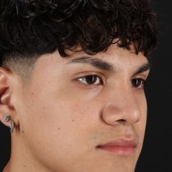 Rhinoplasty Before & After Patient #5517
