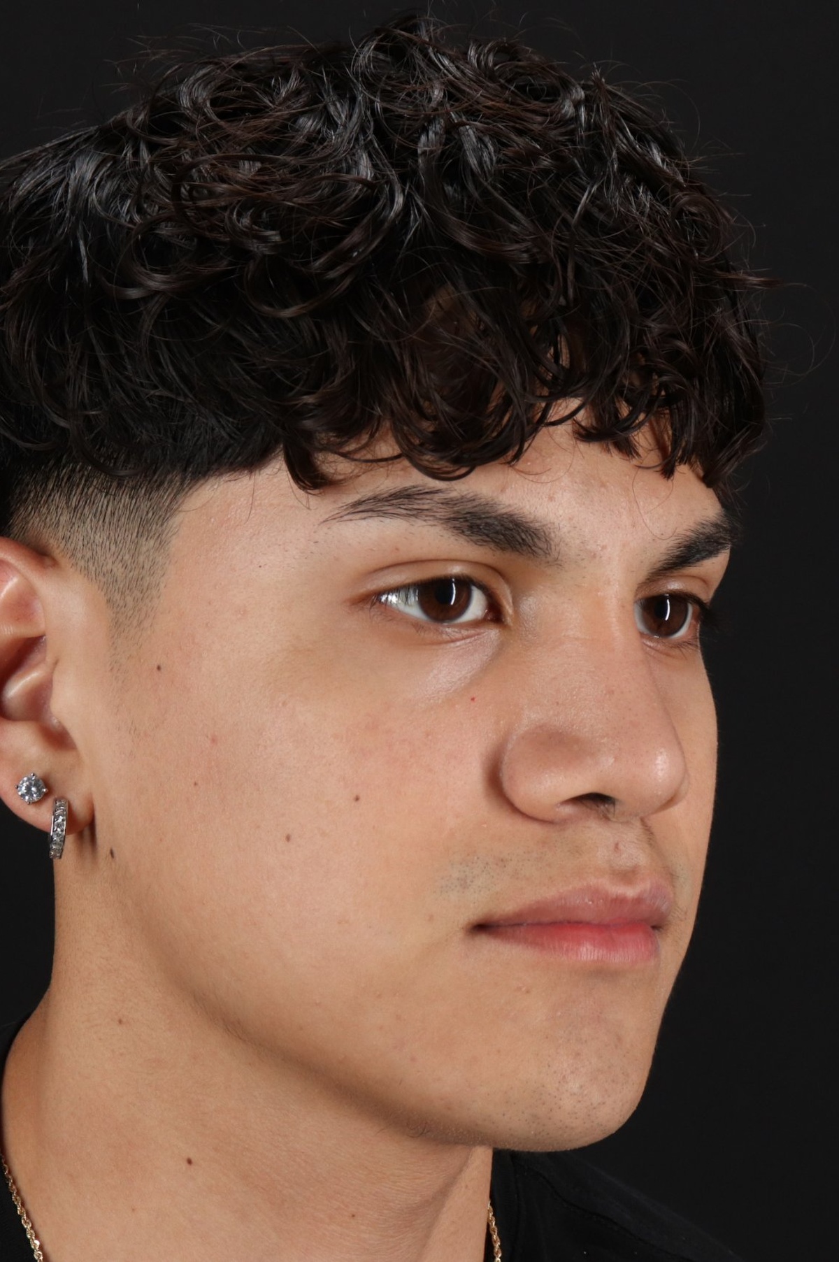 Rhinoplasty Before & After Patient #5517