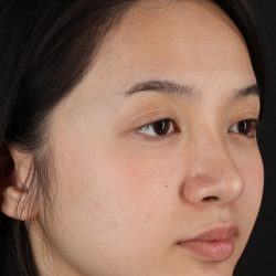 Rhinoplasty Before & After Patient #5573