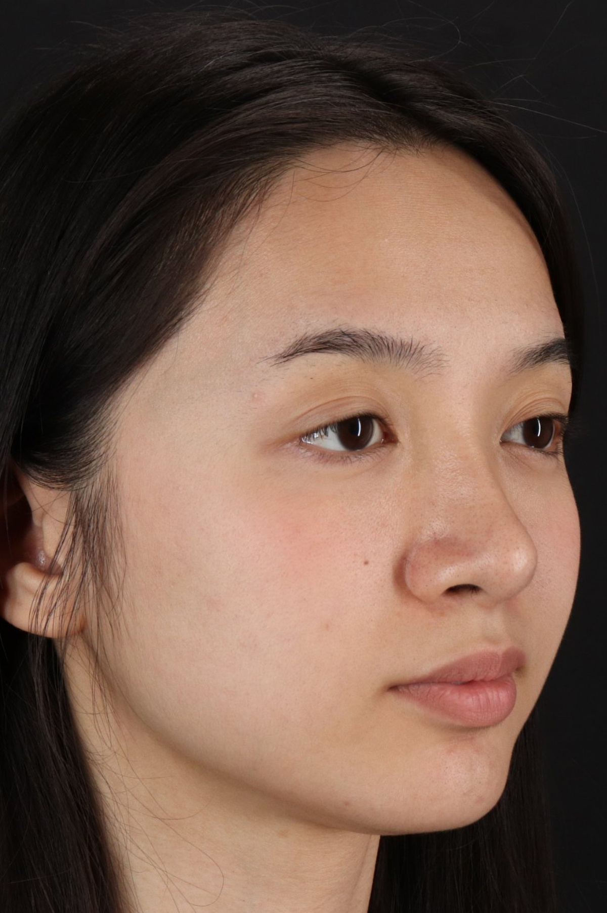 Rhinoplasty Before & After Patient #5573