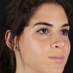 Rhinoplasty Before & After Patient #5572