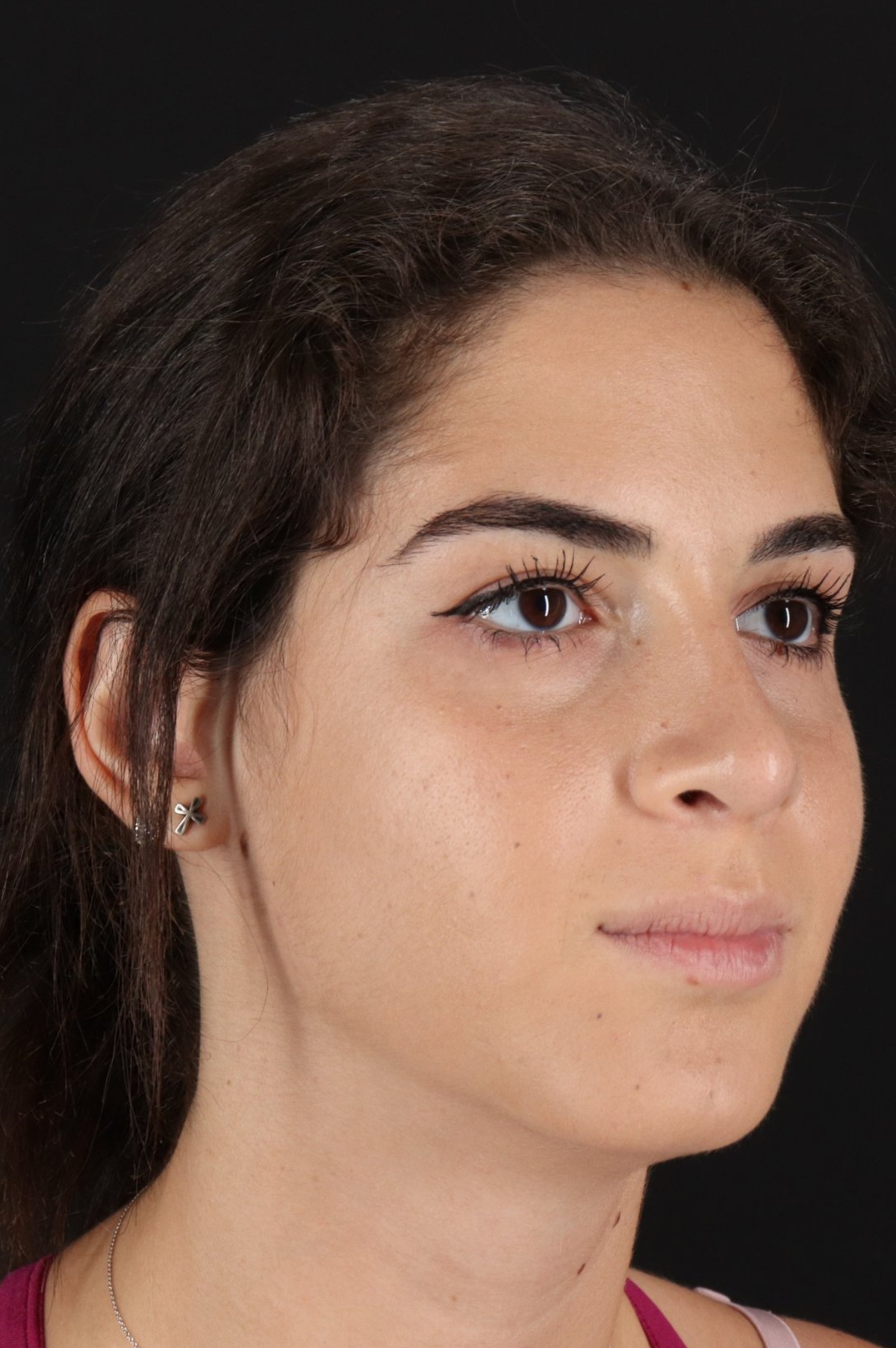 Rhinoplasty Before & After Patient #5572