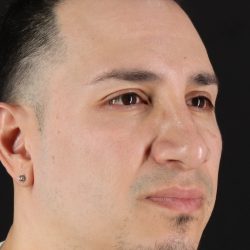Rhinoplasty Before & After Patient #5518