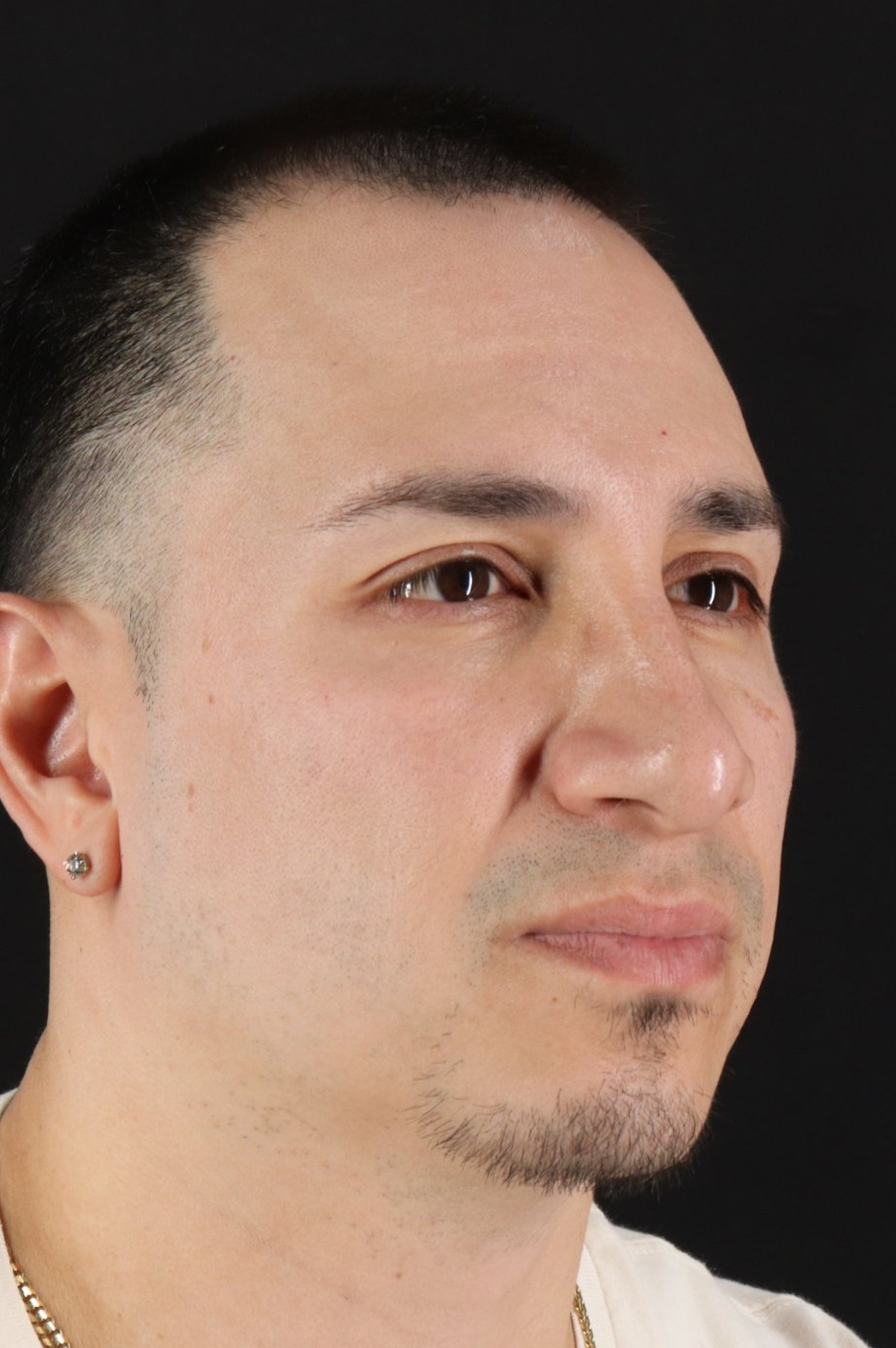 Rhinoplasty Before & After Patient #5518