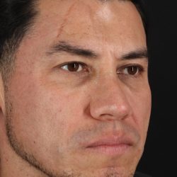 Rhinoplasty Before & After Patient #5519