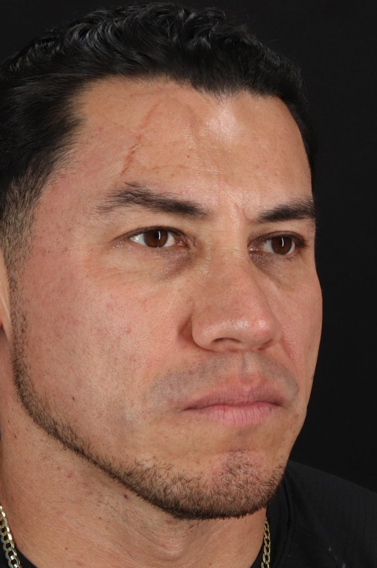 Rhinoplasty Before & After Patient #5519
