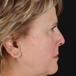 Neck Lift Before & After Patient #5393