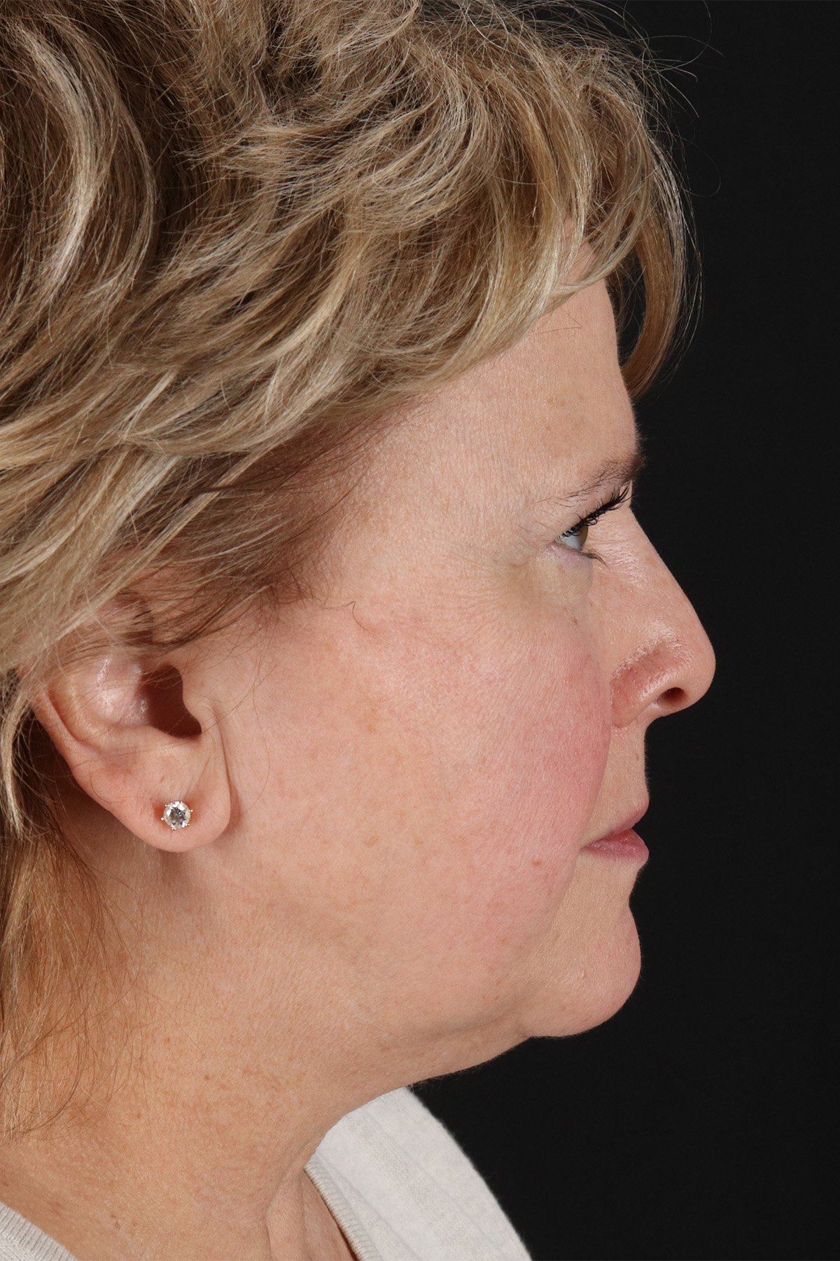 Facelift Before & After Patient #5392