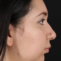 Neck Lift Before & After Patient #5395