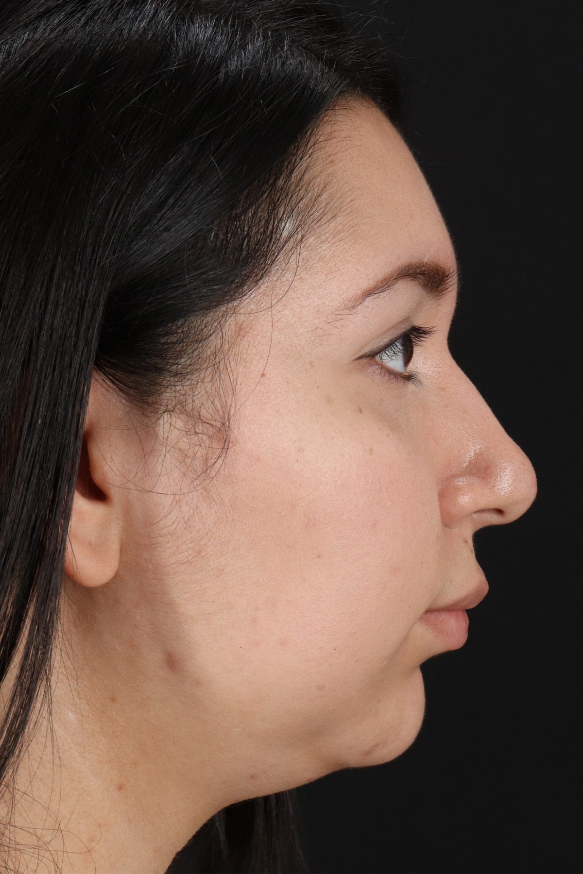 Neck Lift Before & After Patient #5395