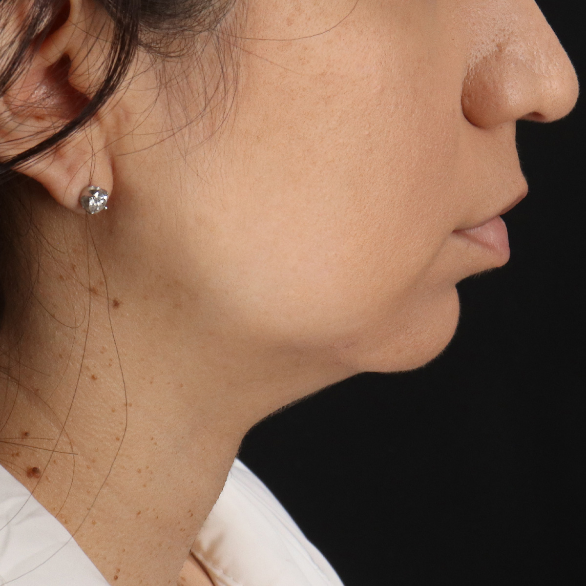 Neck Lift Before & After Patient #5396