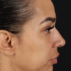 Chin Implant Before & After Patient #5390
