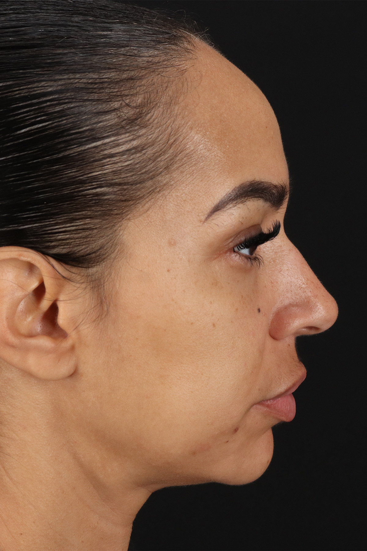 Chin Implant Before & After Patient #5390