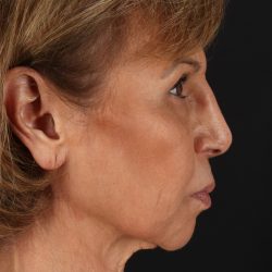 Facelift Before & After Patient #5394
