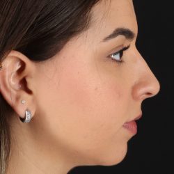 Chin Implant Before & After Patient #5391