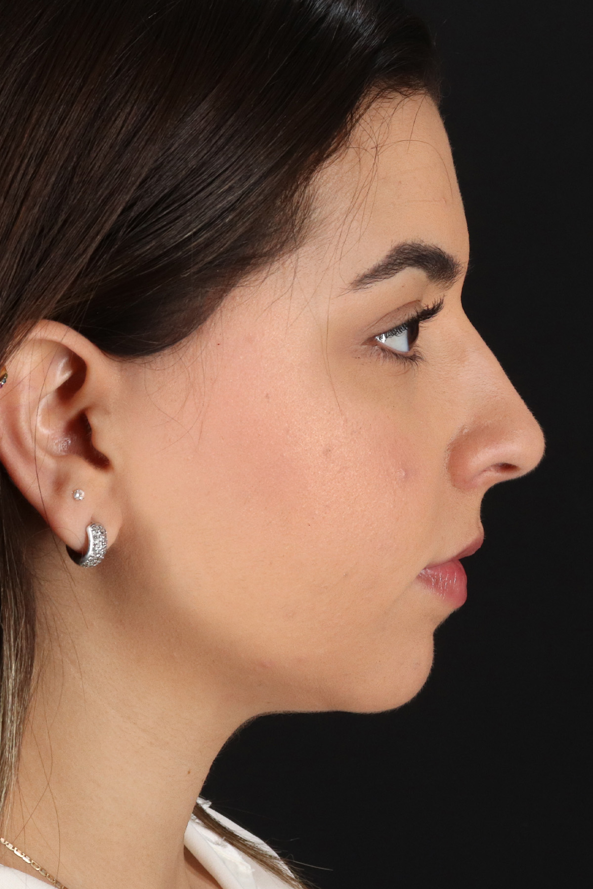 Chin Implant Before & After Patient #5391