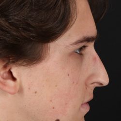 Rhinoplasty Before & After Patient #5515