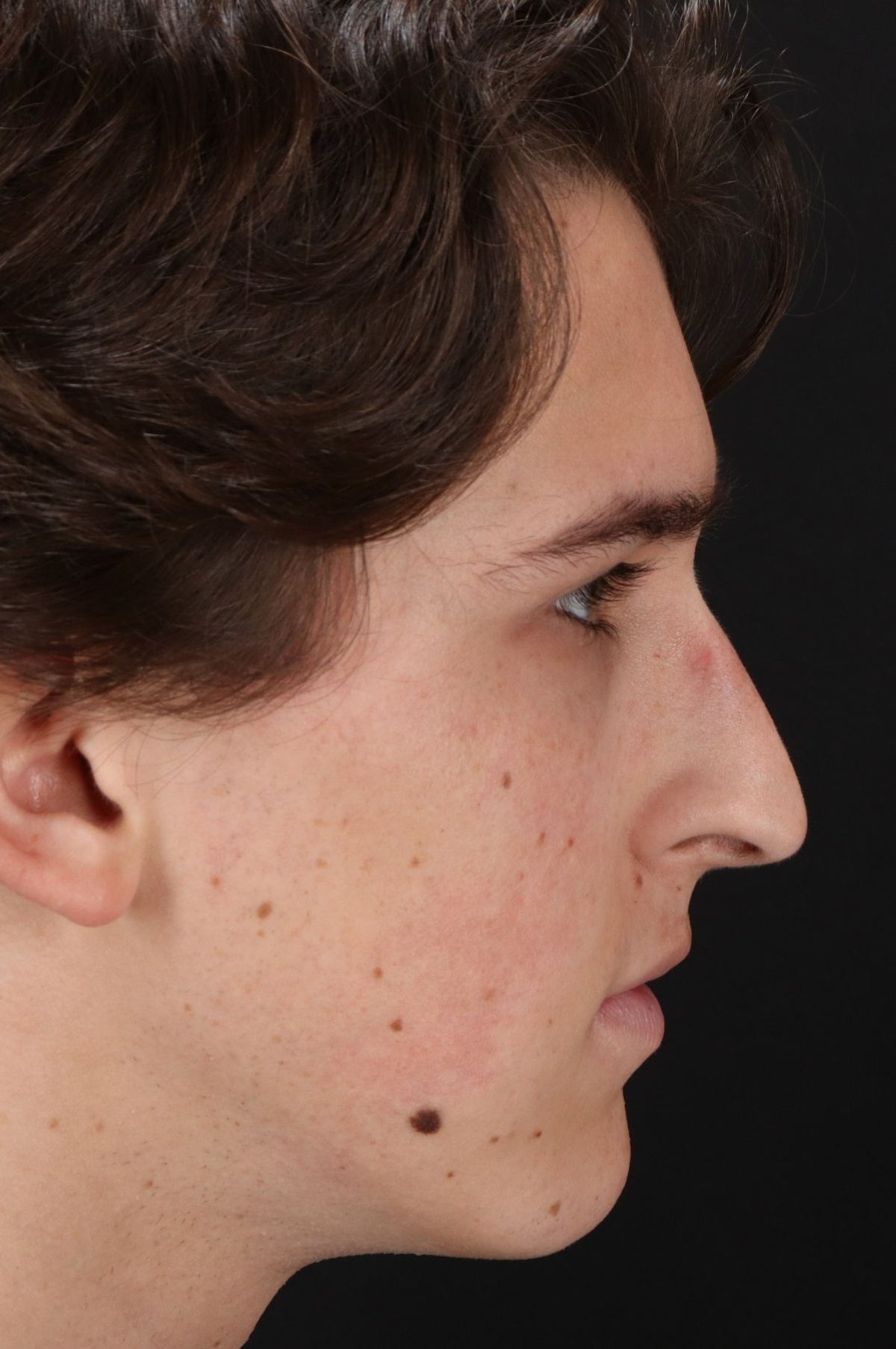 Rhinoplasty Before & After Patient #5515
