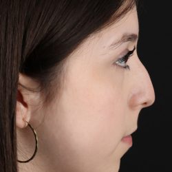 Rhinoplasty Before & After Patient #5575