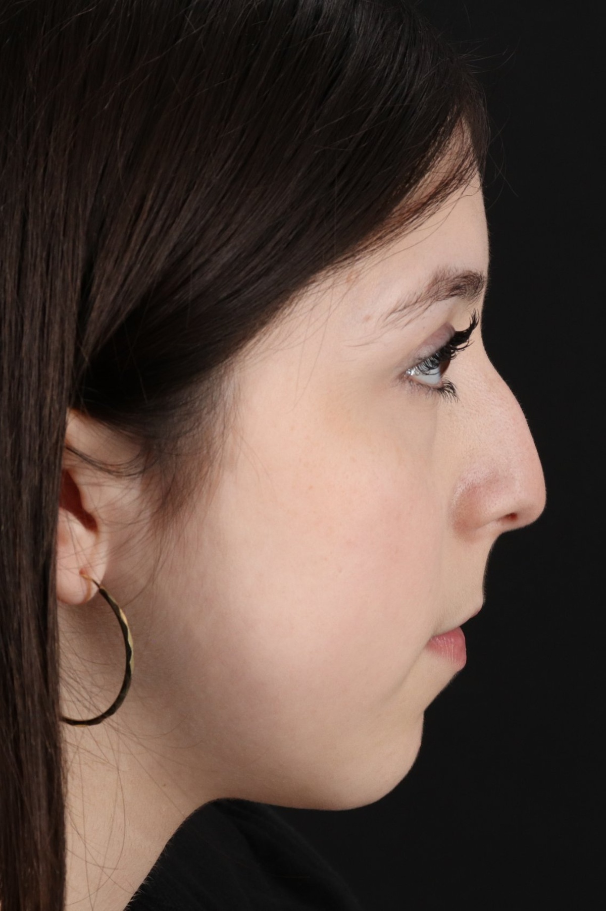 Rhinoplasty Before & After Patient #5575