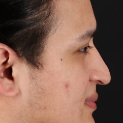 Rhinoplasty Before & After Patient #5516