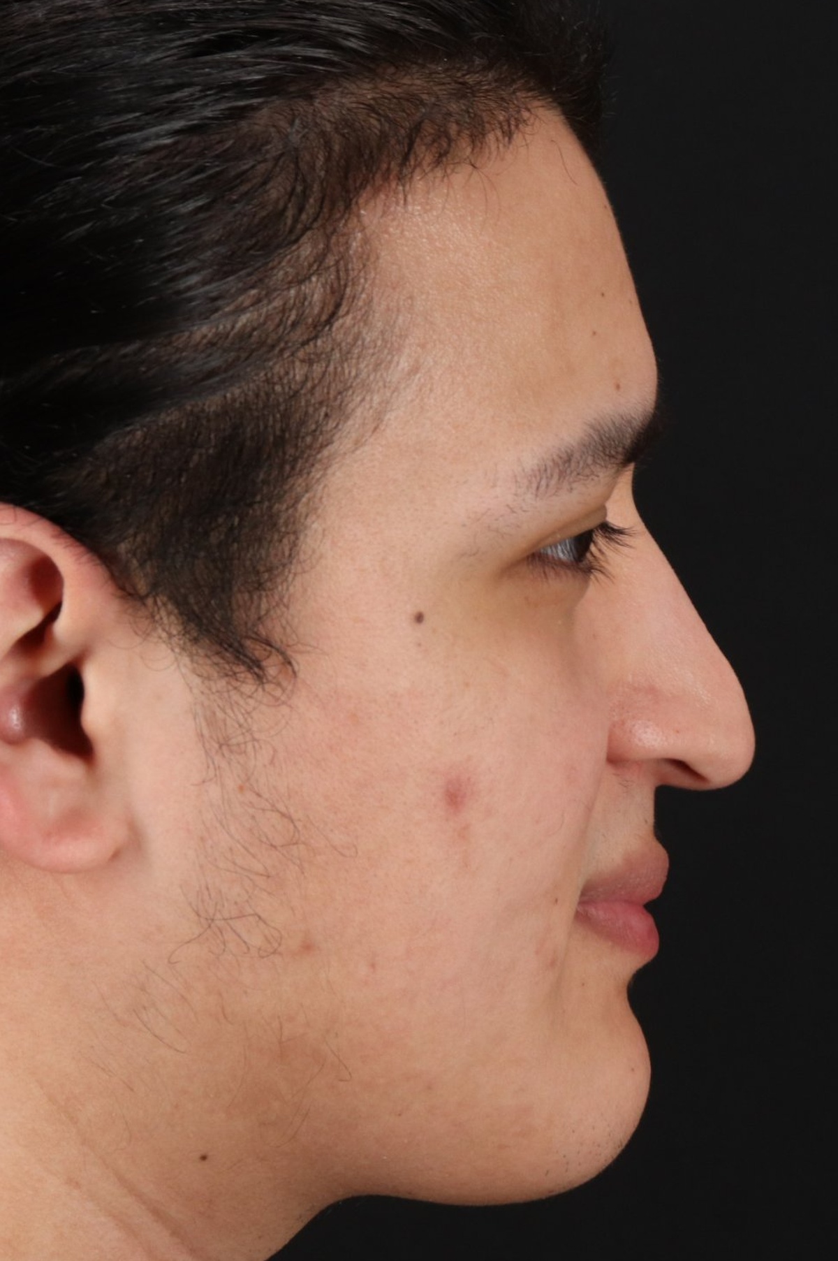 Rhinoplasty Before & After Patient #5516