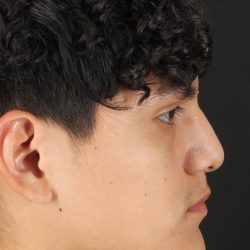 Rhinoplasty Before & After Patient #5517