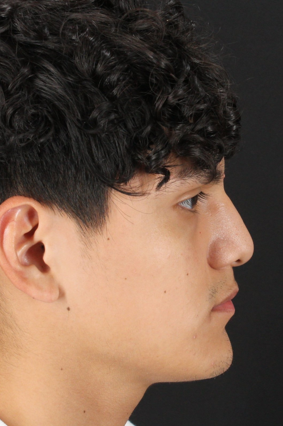 Rhinoplasty Before & After Patient #5517