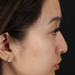 Rhinoplasty Before & After Patient #5573