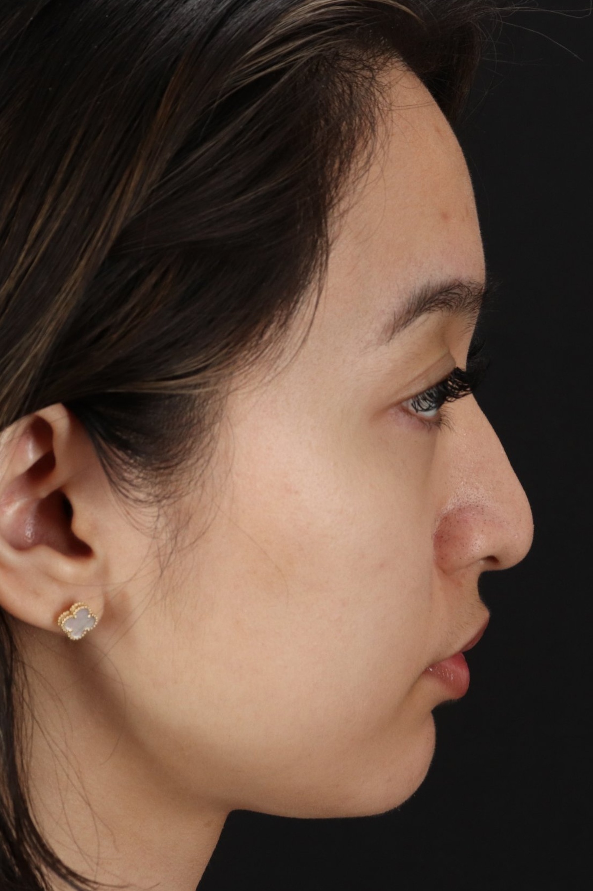 Rhinoplasty Before & After Patient #5573