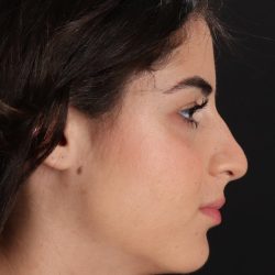 Rhinoplasty Before & After Patient #5572