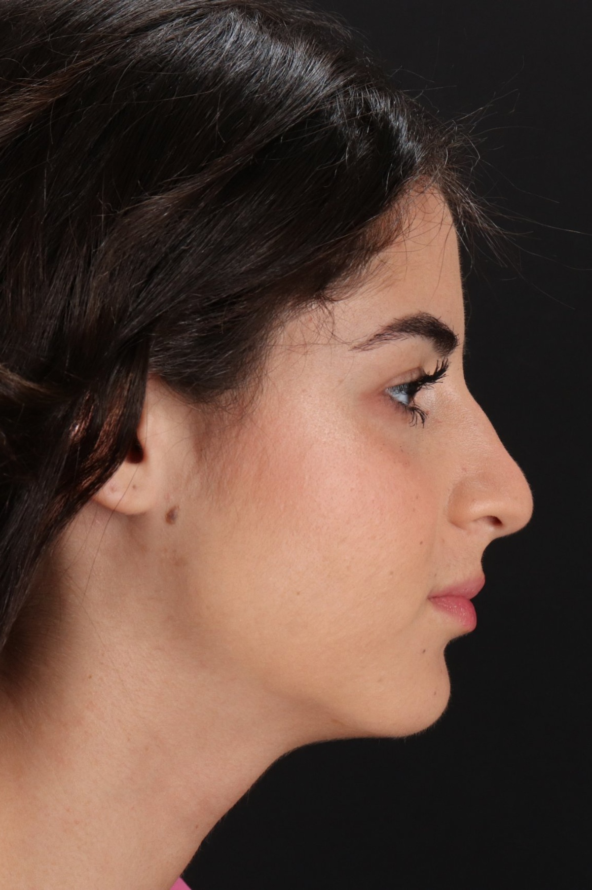 Rhinoplasty Before & After Patient #5572