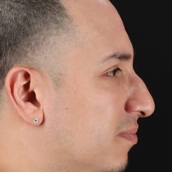 Rhinoplasty Before & After Patient #5518