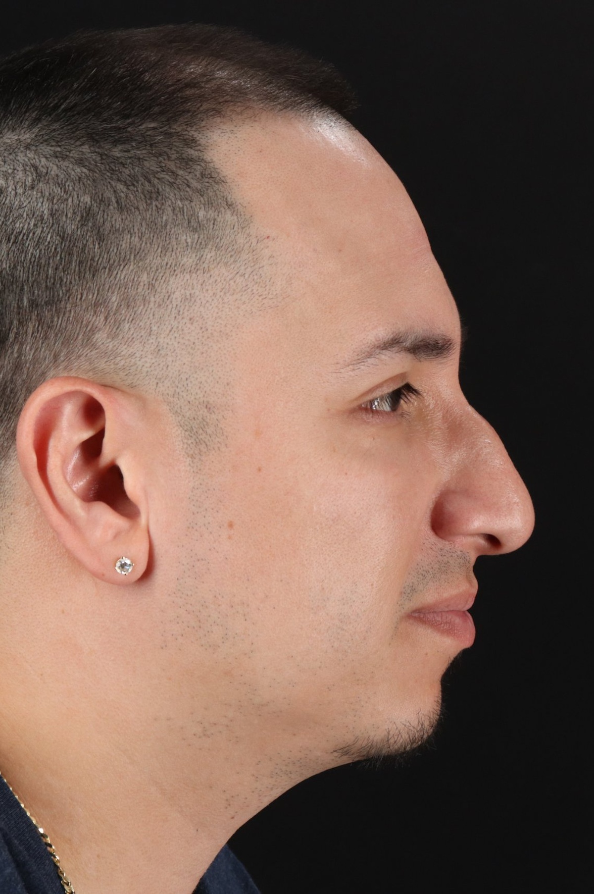 Rhinoplasty Before & After Patient #5518