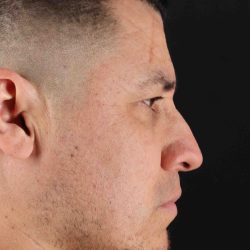 Rhinoplasty Before & After Patient #5519