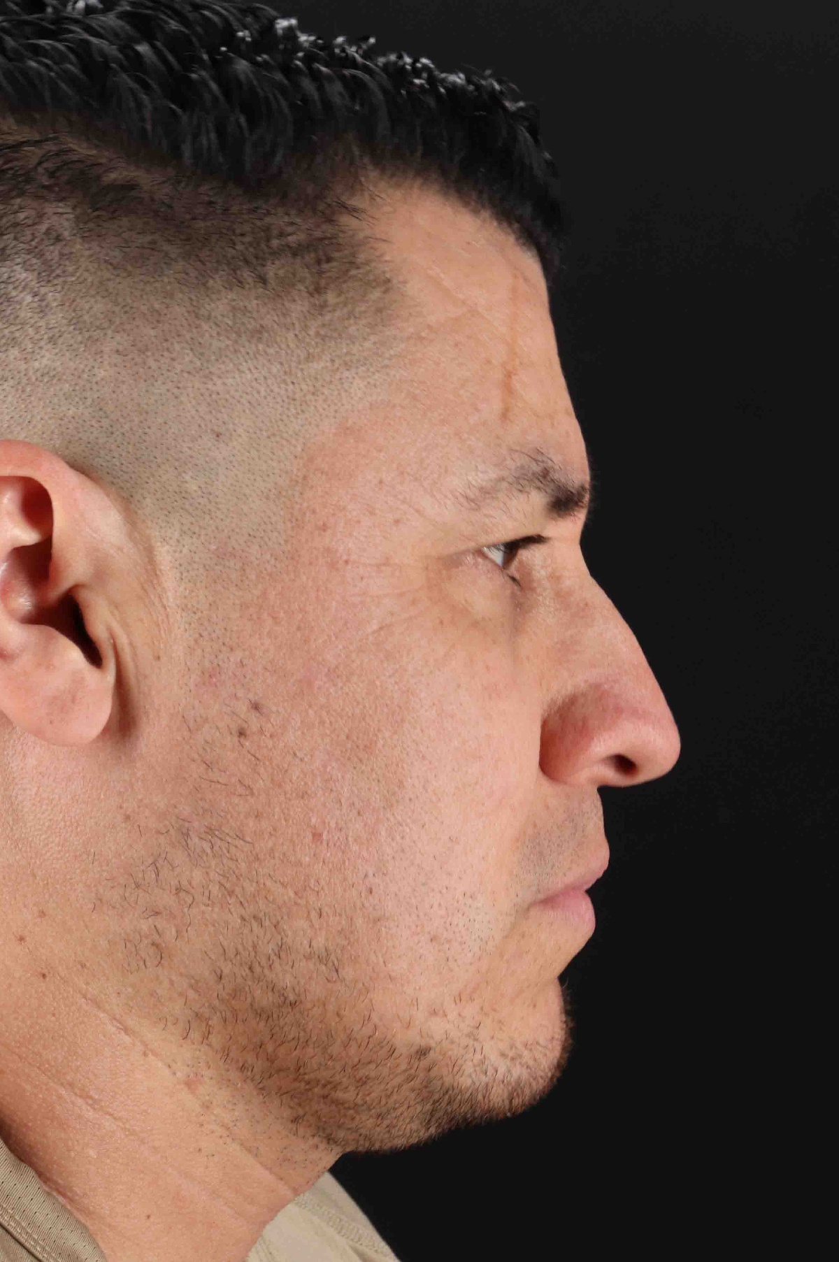 Rhinoplasty Before & After Patient #5519