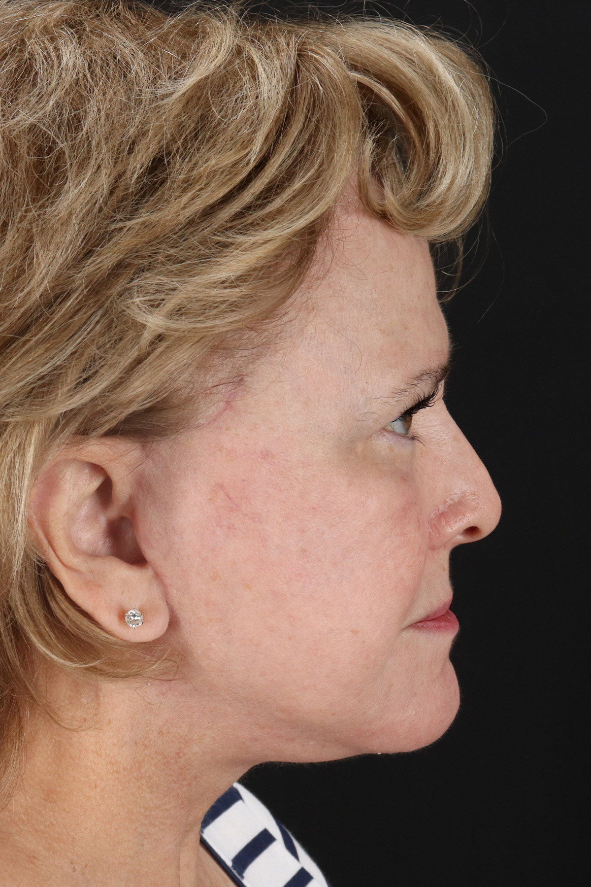 Neck Lift Before & After Patient #5393