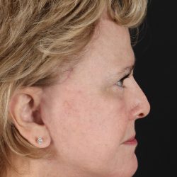 Facelift Before & After Patient #5392