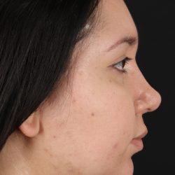 Neck Lift Before & After Patient #5395