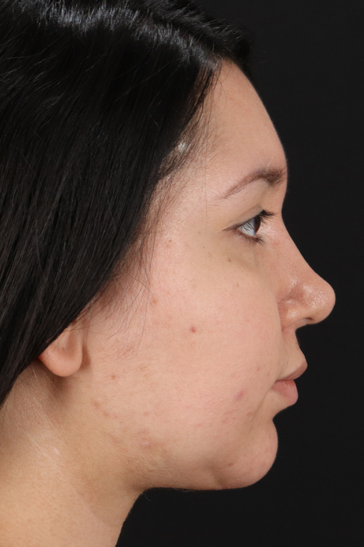 Neck Lift Before & After Patient #5395