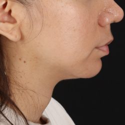 Neck Lift Before & After Patient #5396