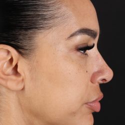 Chin Implant Before & After Patient #5390