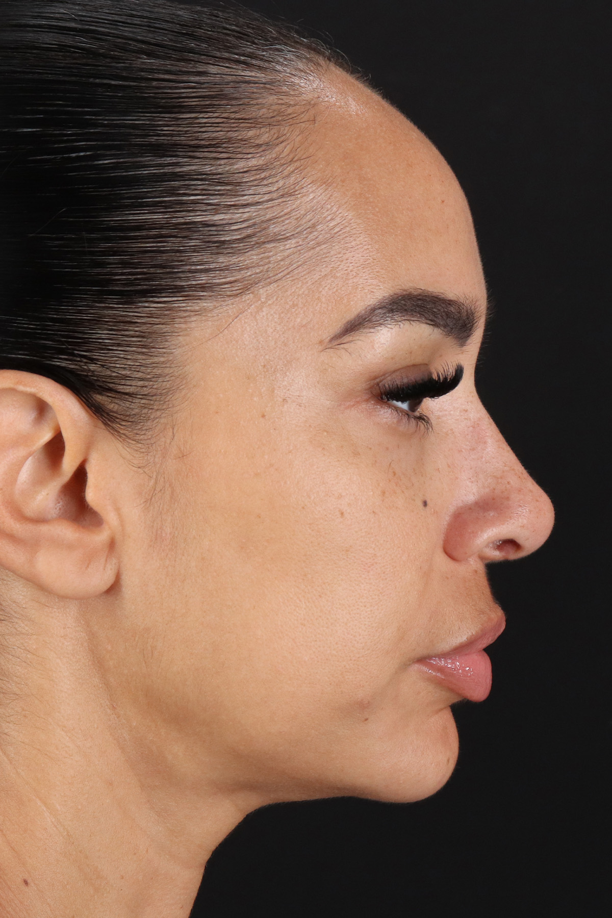 Chin Implant Before & After Patient #5390