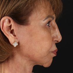 Facelift Before & After Patient #5394