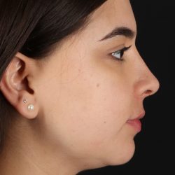 Chin Implant Before & After Patient #5391