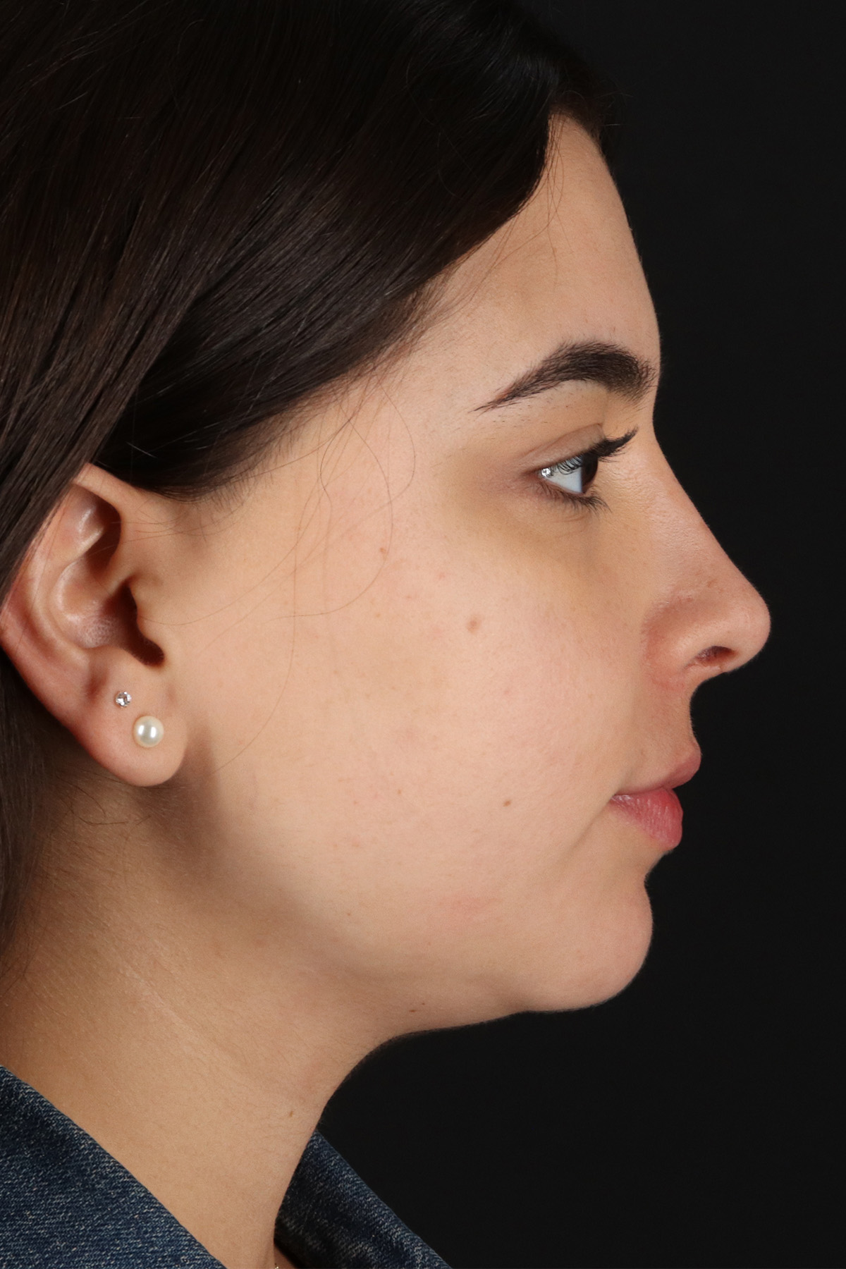 Chin Implant Before & After Patient #5391