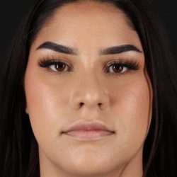 Rhinoplasty Before & After Patient #5574