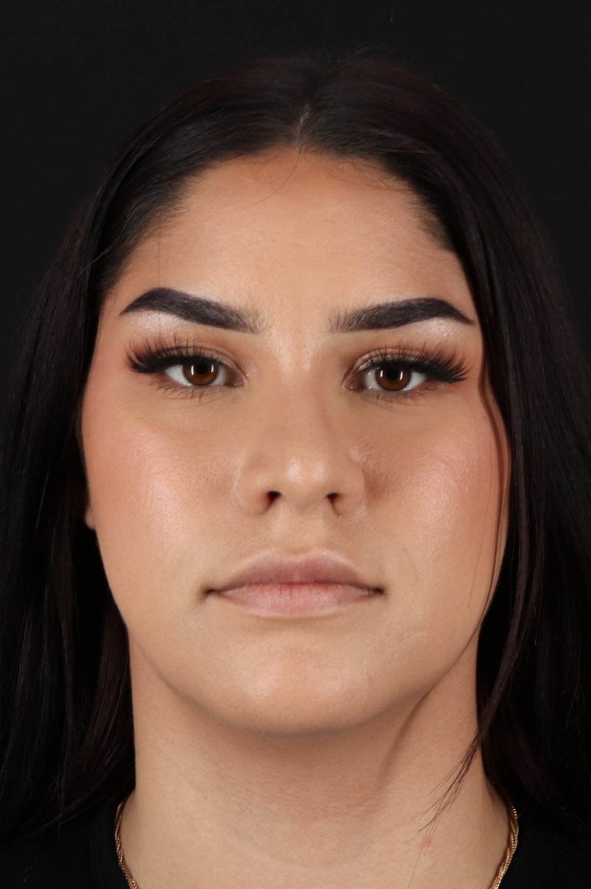 Rhinoplasty Before & After Patient #5574