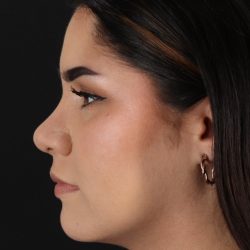Rhinoplasty Before & After Patient #5574