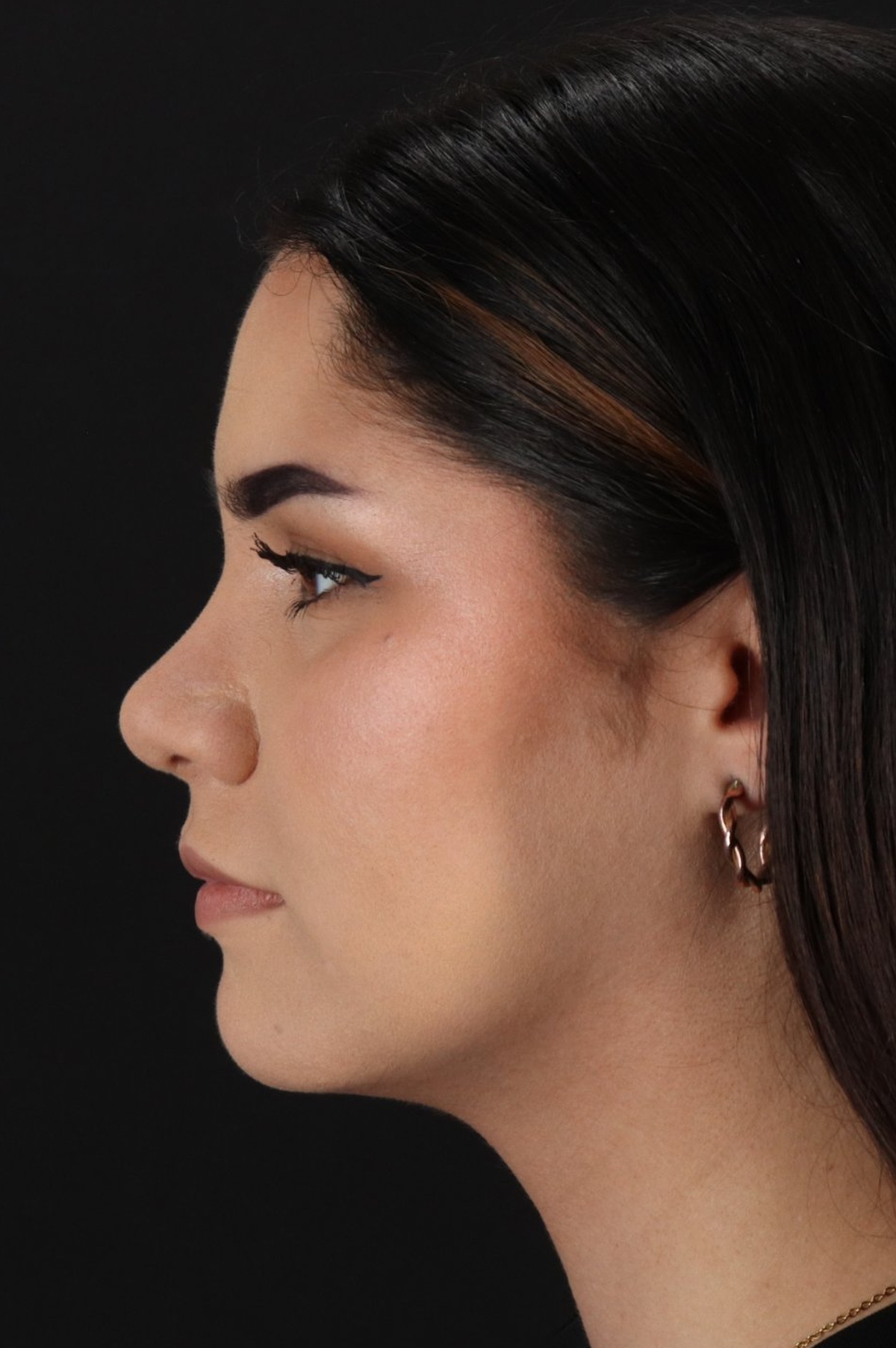 Rhinoplasty Before & After Patient #5574